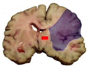 middle cerebral artery stroke